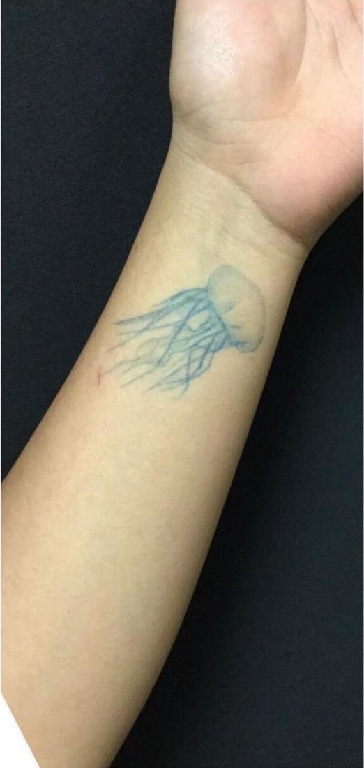 Before: Blue wrist tattoo