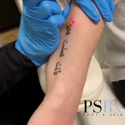Before: Tattoo removal, arm