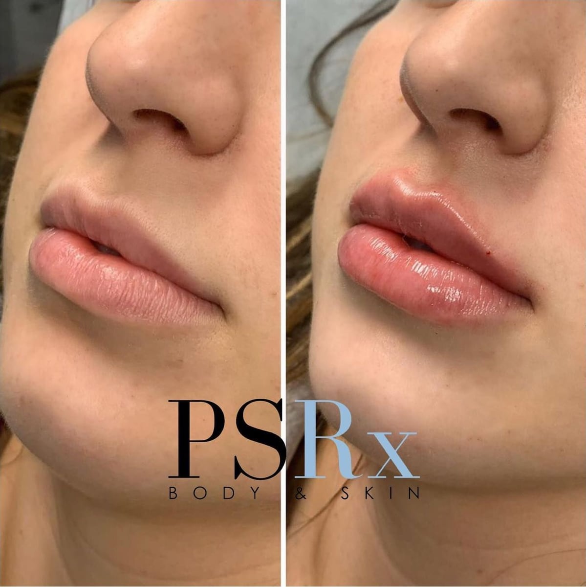Before and after: Filler, lips