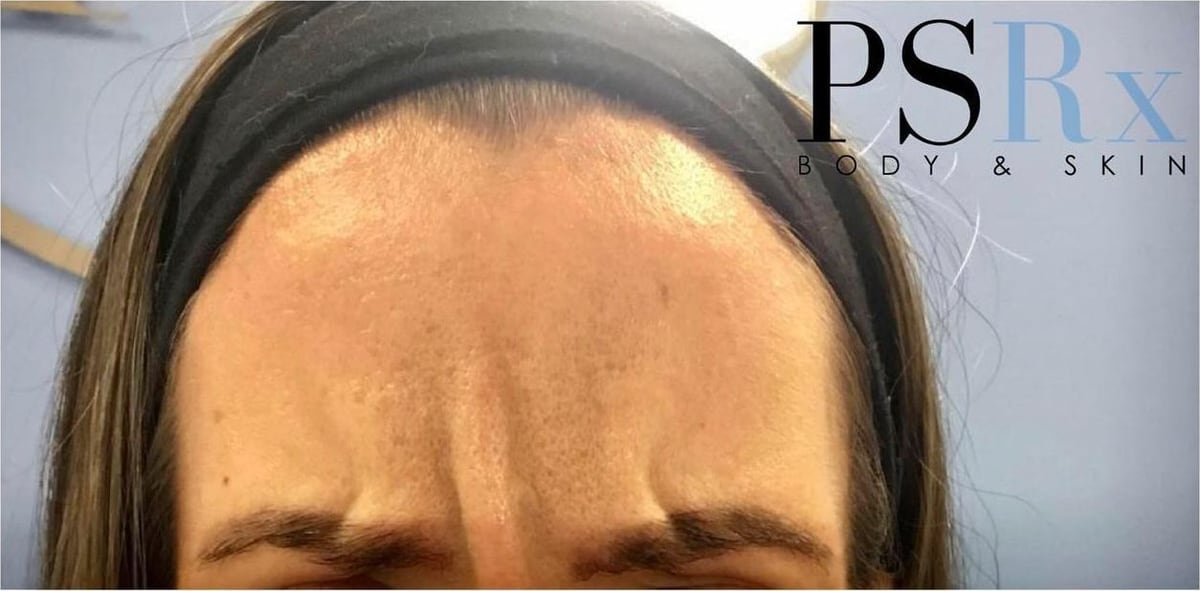 After: Neurotoxin, forehead