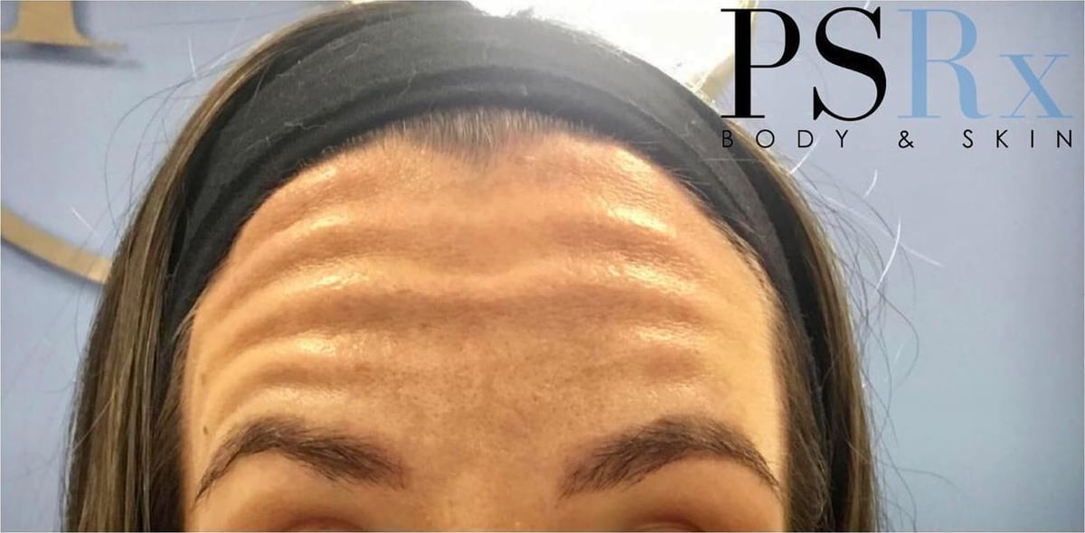 Before: Neurotoxin, forehead