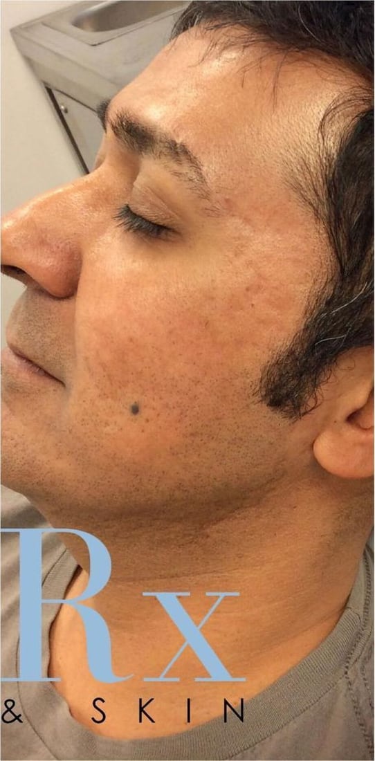 After: Deep acne scars