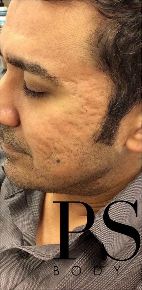 Before: Deep acne scars
