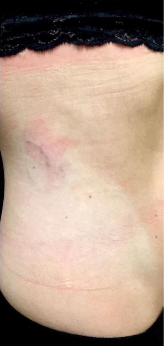 After: Tattoo removal, abdomen