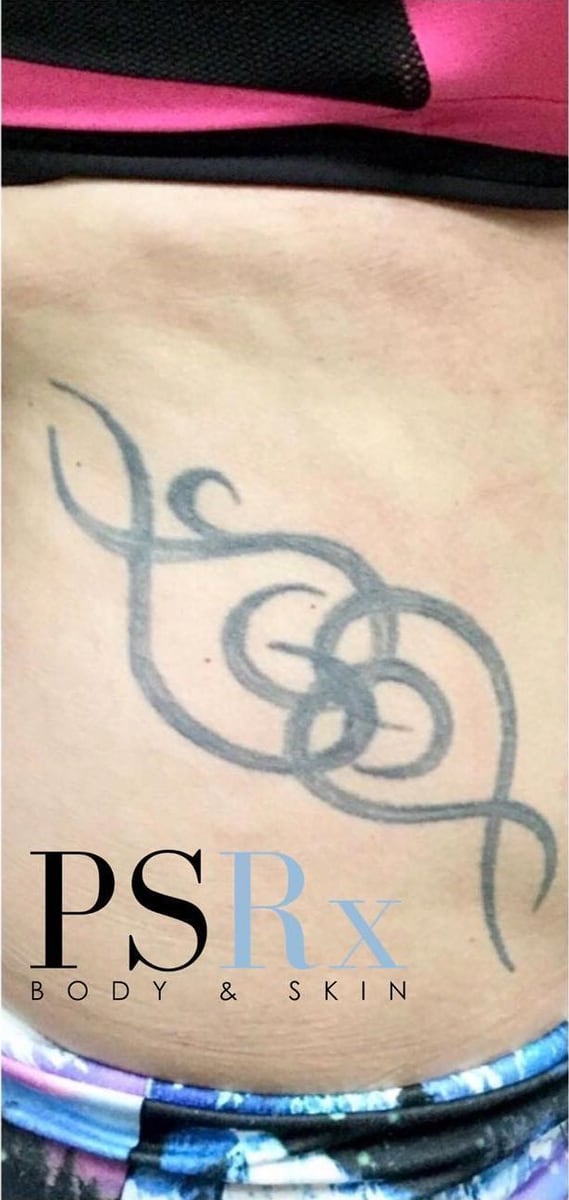 Before: Tattoo removal, abdomen