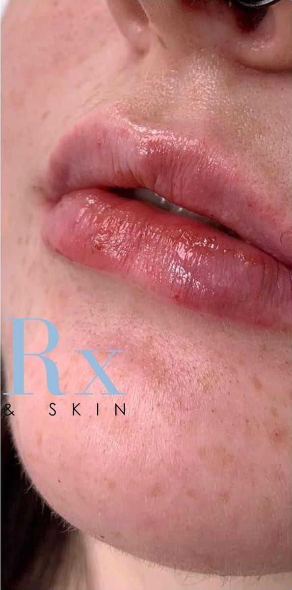 After: Filler, lips