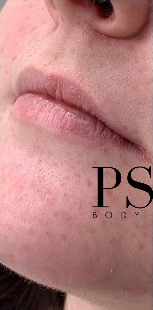 Before: Filler, lips
