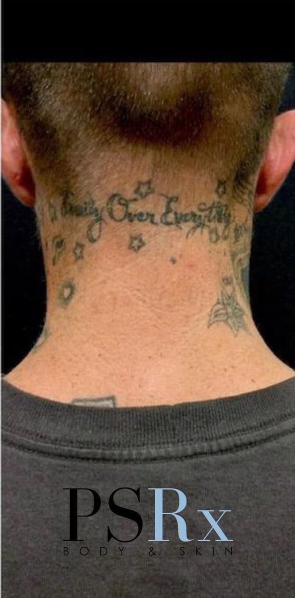 After: Tattoo removal, neck