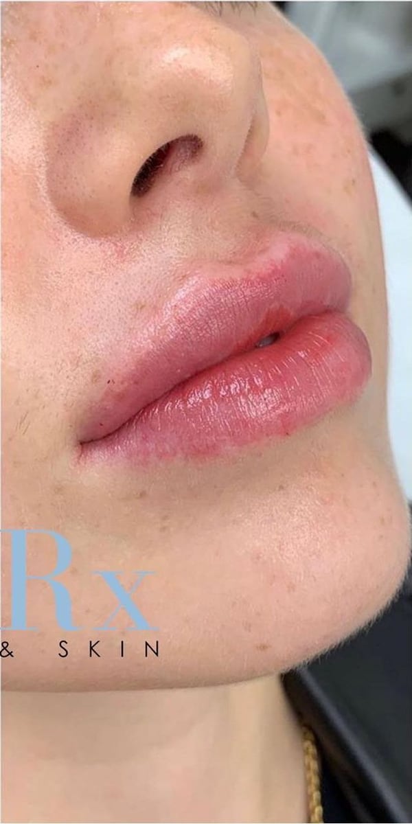 After: Filler, lips