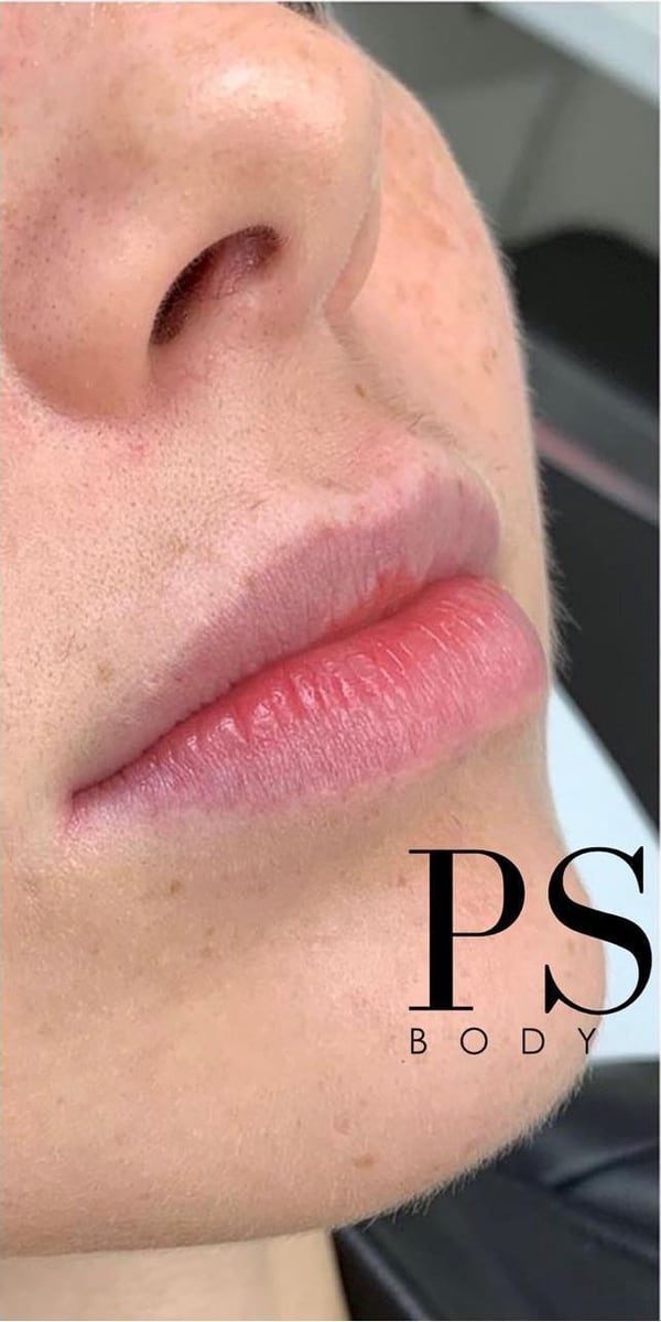 Before: Filler, lips