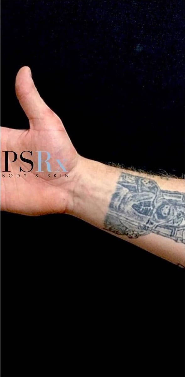 After: Tattoo removal, arm