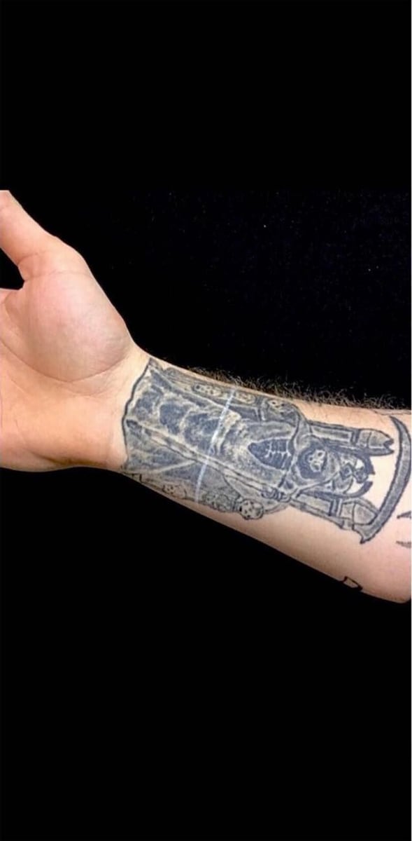 Before: Tattoo removal, arm