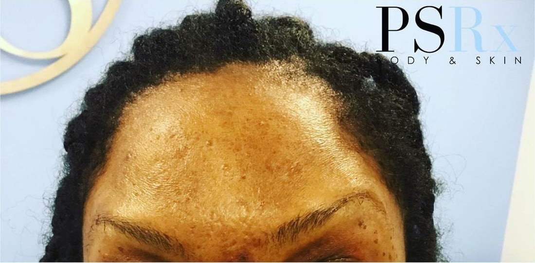 After: Forehead lines