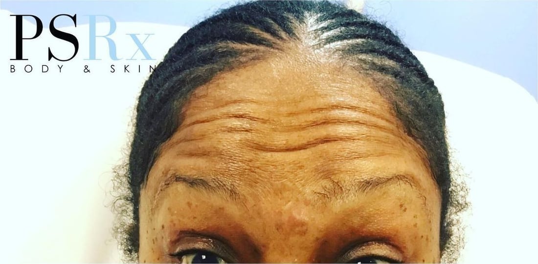 Before: Forehead lines