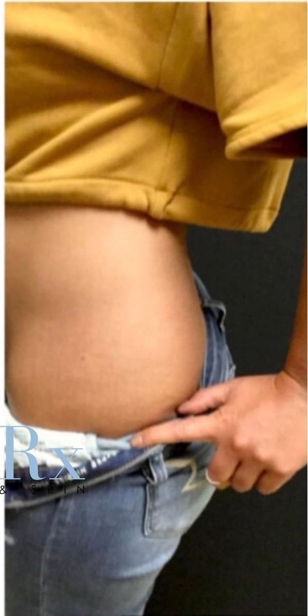 After: Tattoo removal, abdomen
