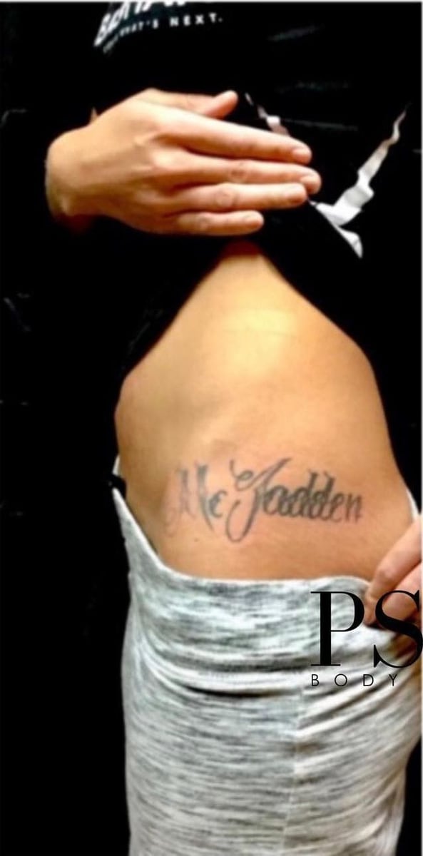 Before: Tattoo removal, abdomen