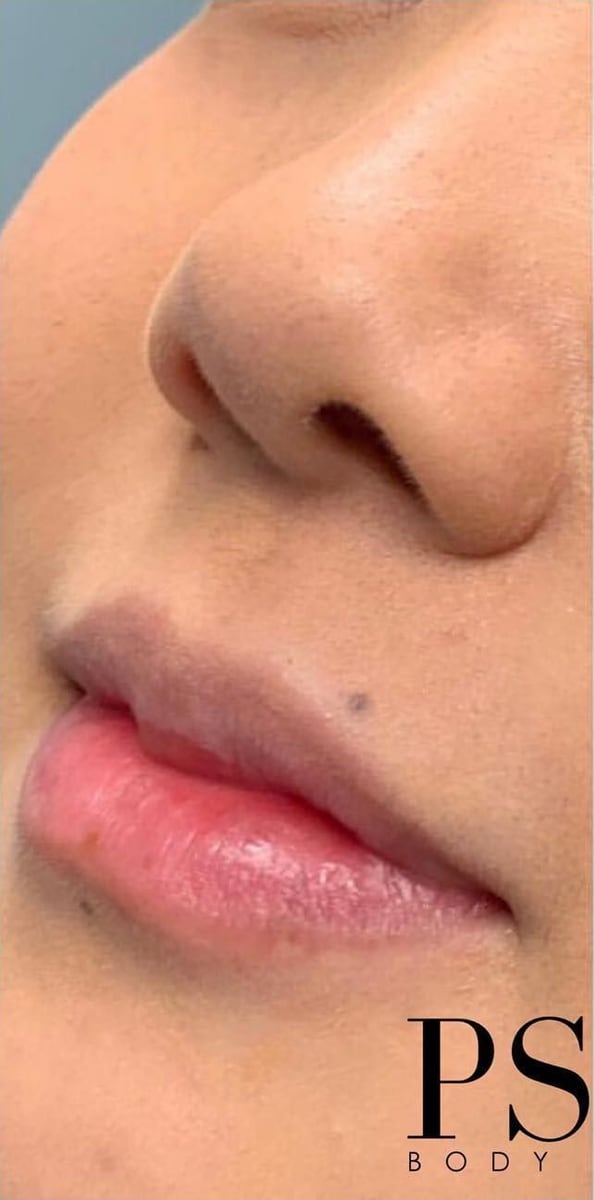 Before: Filler, lips