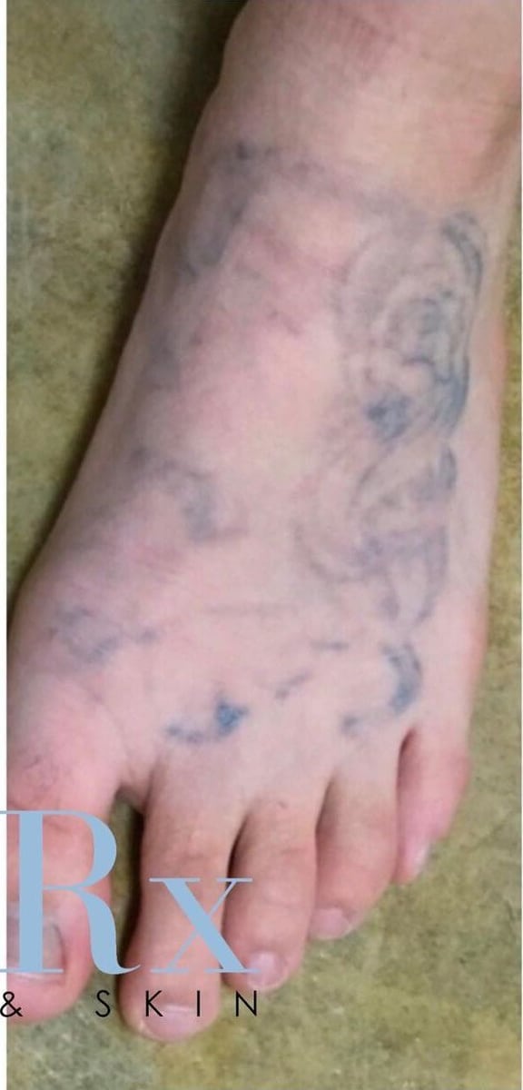 After: Tattoo removal, legs