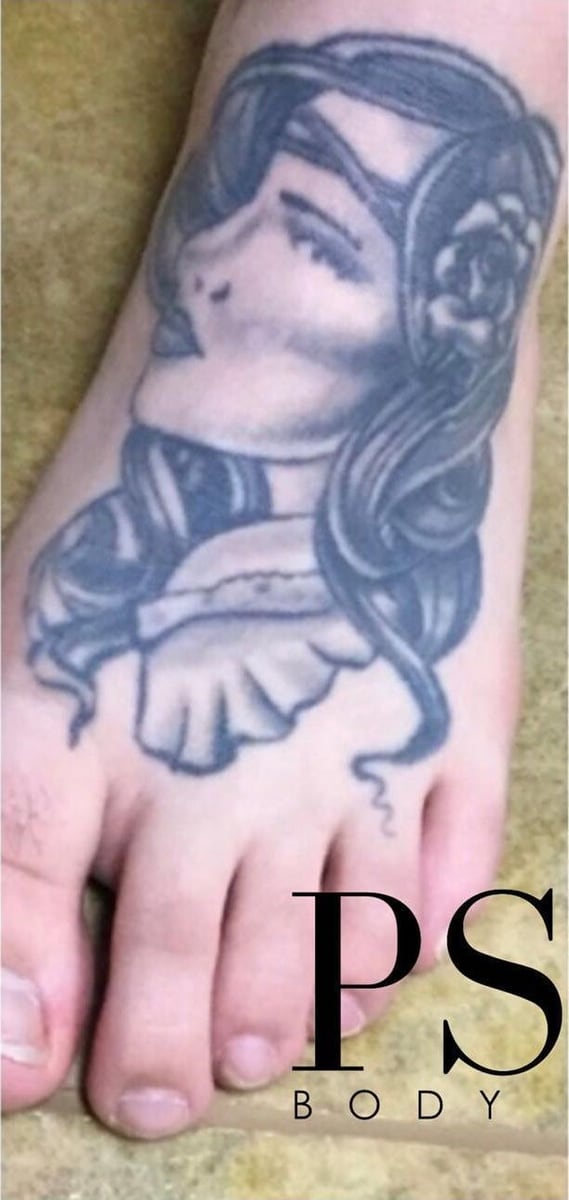Before: Tattoo removal, legs