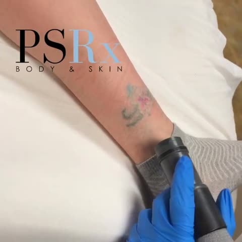 After: Tattoo removal, arm