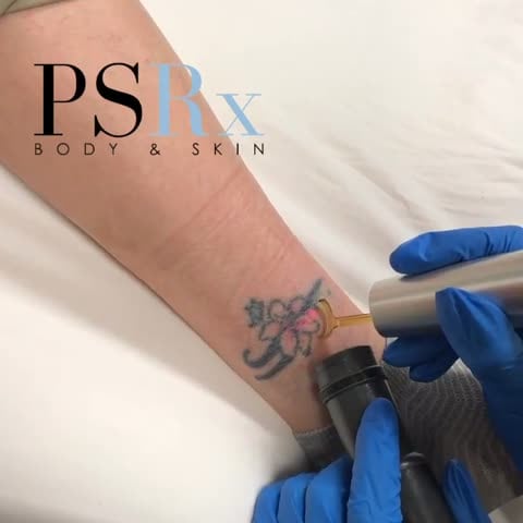 Before: Tattoo removal, arm