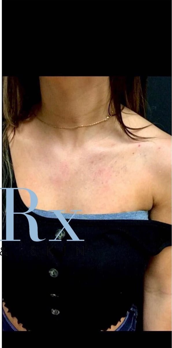 After: Tattoo removal, chest