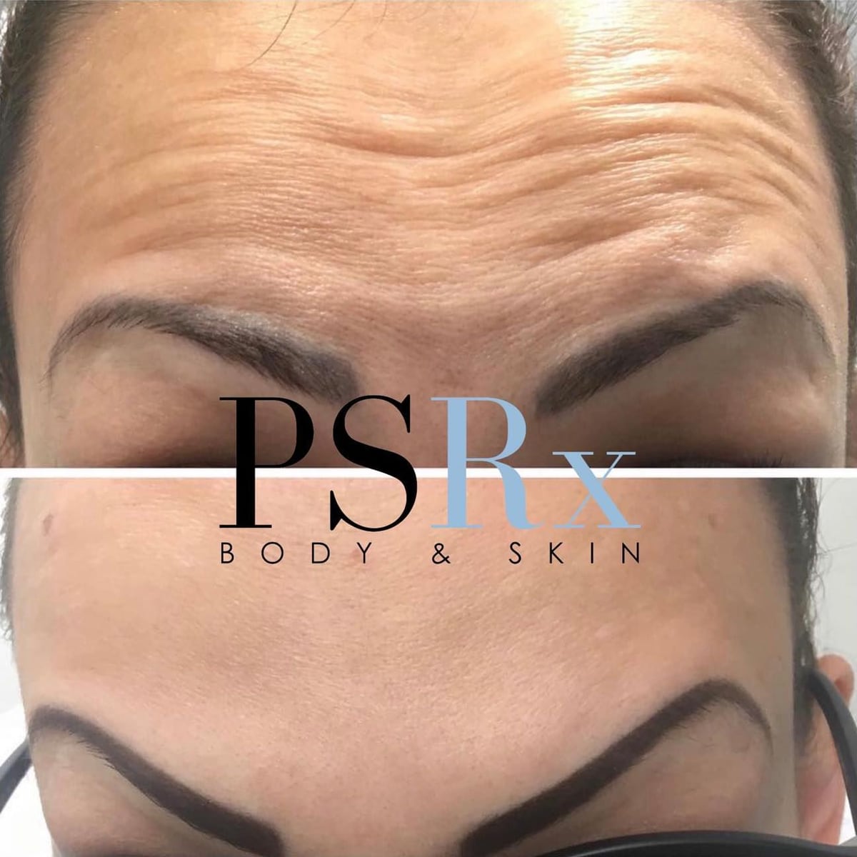 Before and after: Neurotoxin, forehead
