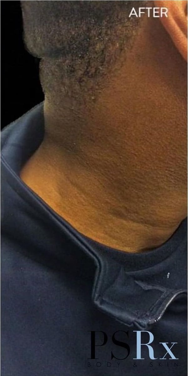 After: Tattoo removal, neck