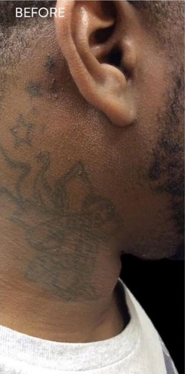 Before: Tattoo removal, neck