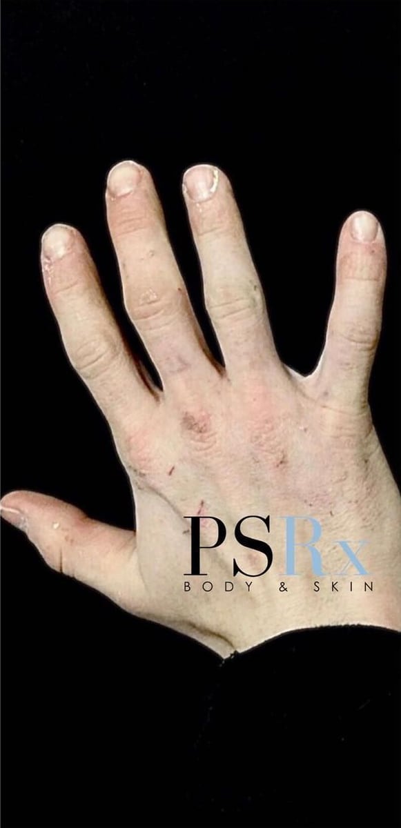 After: Tattoo removal, hand