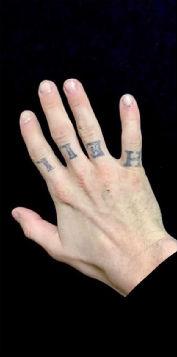 Before: Tattoo removal, hand