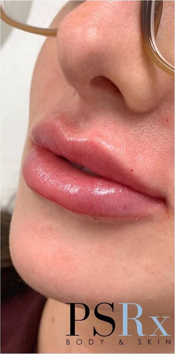 After: Filler, lips