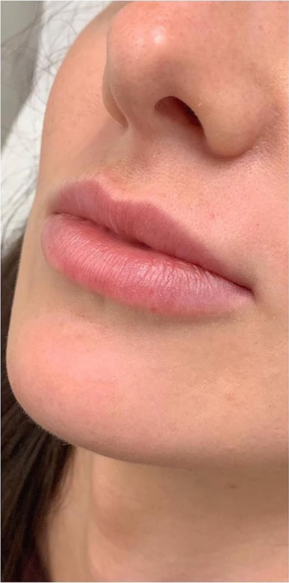 Before: Filler, lips
