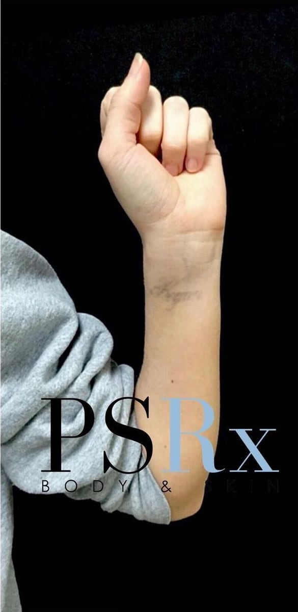 After: Tattoo removal, arm