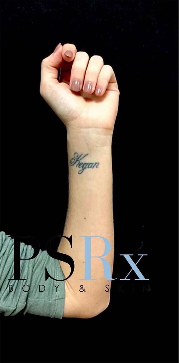 Before: Tattoo removal, arm