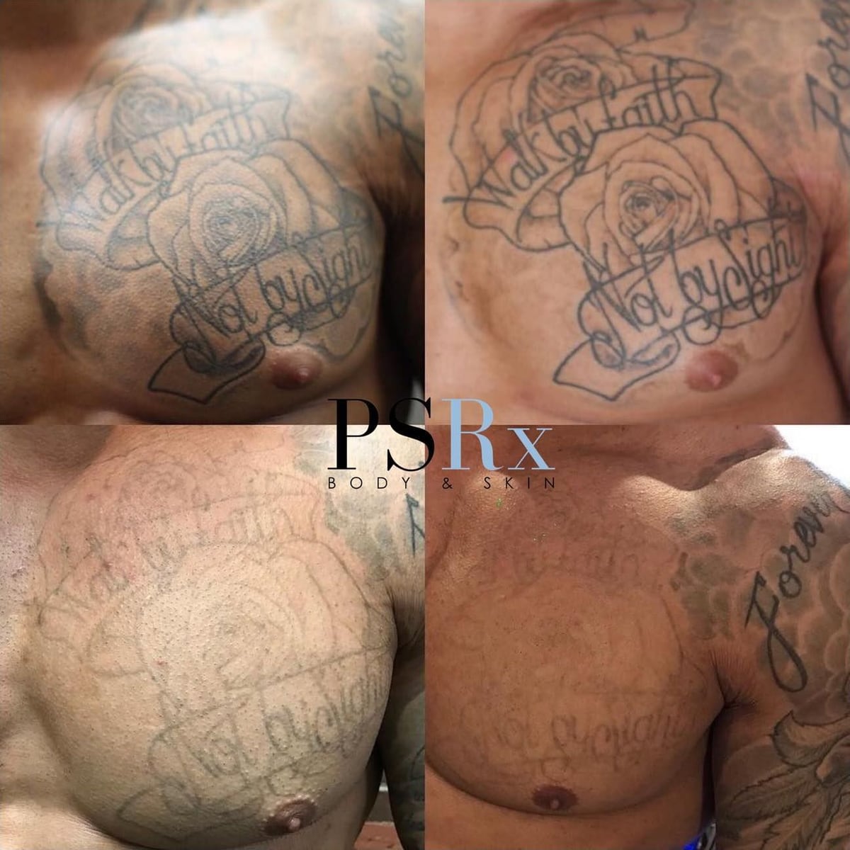Before and after: Tattoo removal, chest