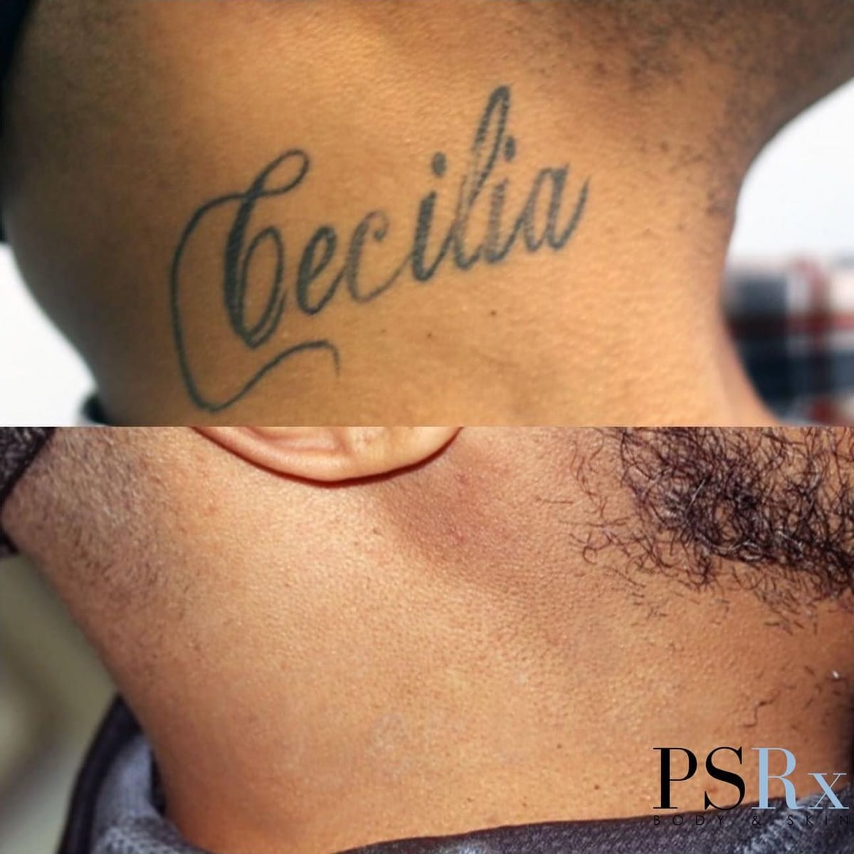 Before and after: Tattoo removal, neck