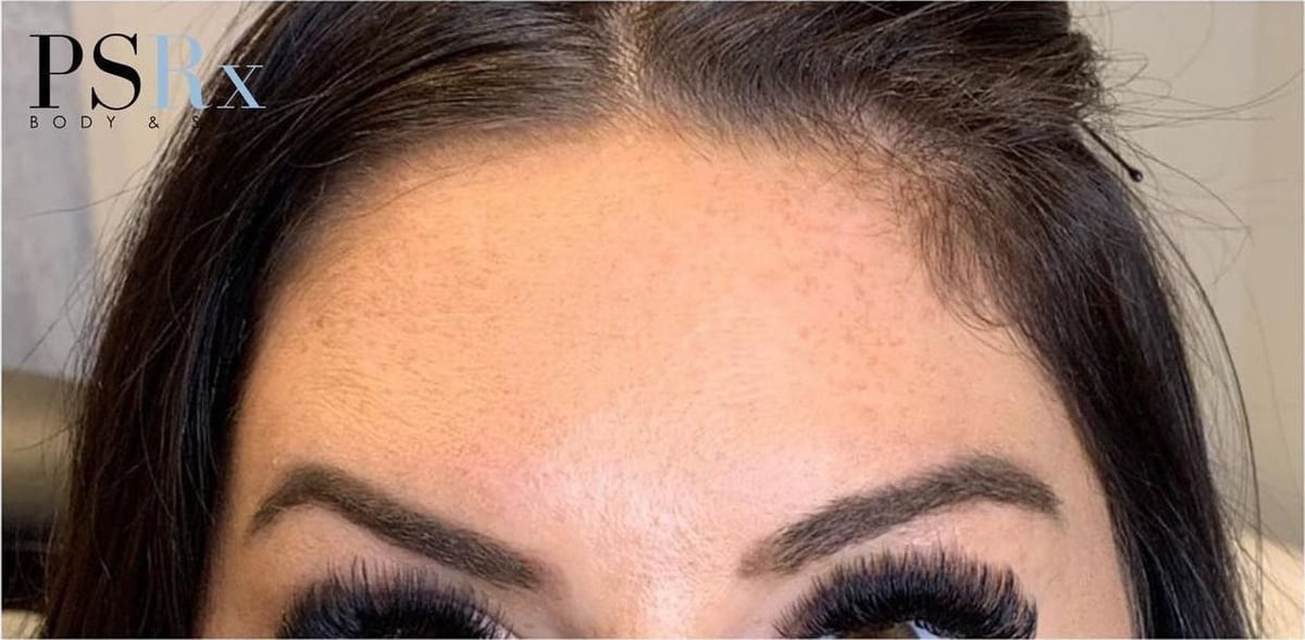 After: Neurotoxin, forehead
