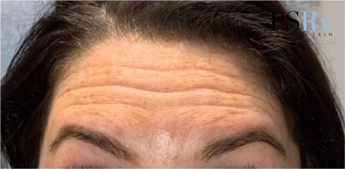 Before: Neurotoxin, forehead
