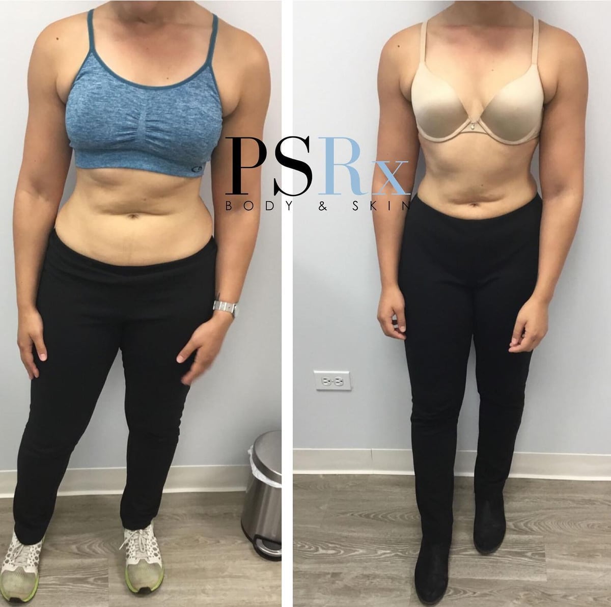 Before and after: Body contouring, abdomen
