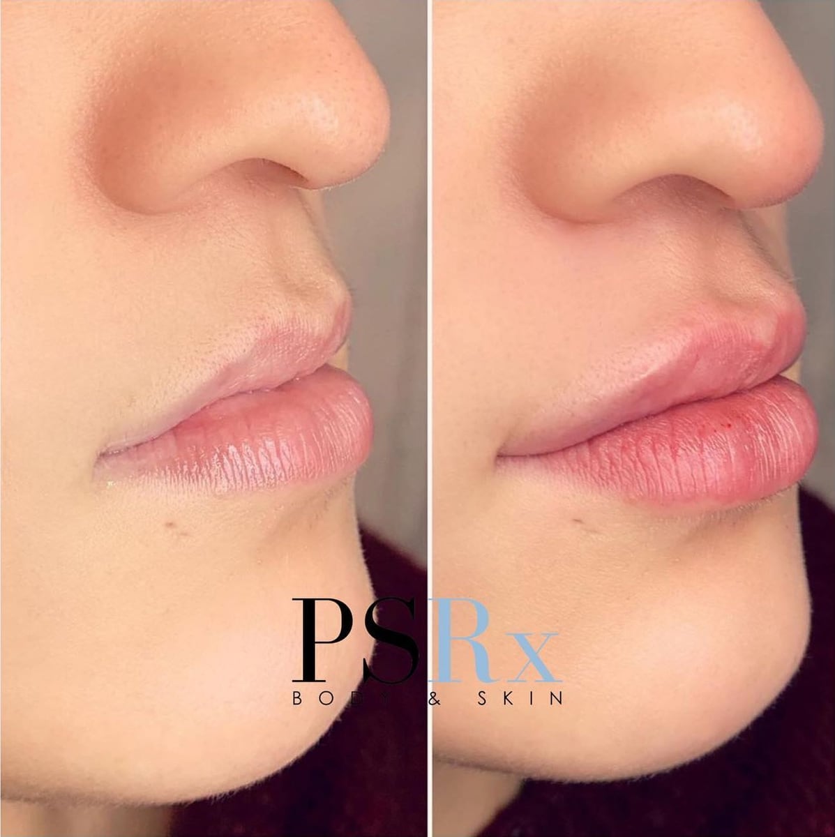 Before and after: Filler, lips