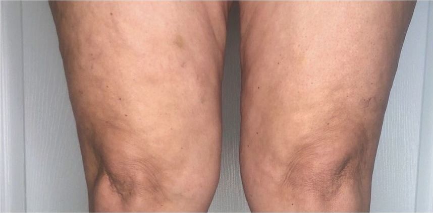 After: Cellulite, back of the thighs
