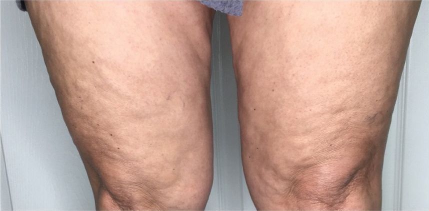 Before: Cellulite, back of the thighs