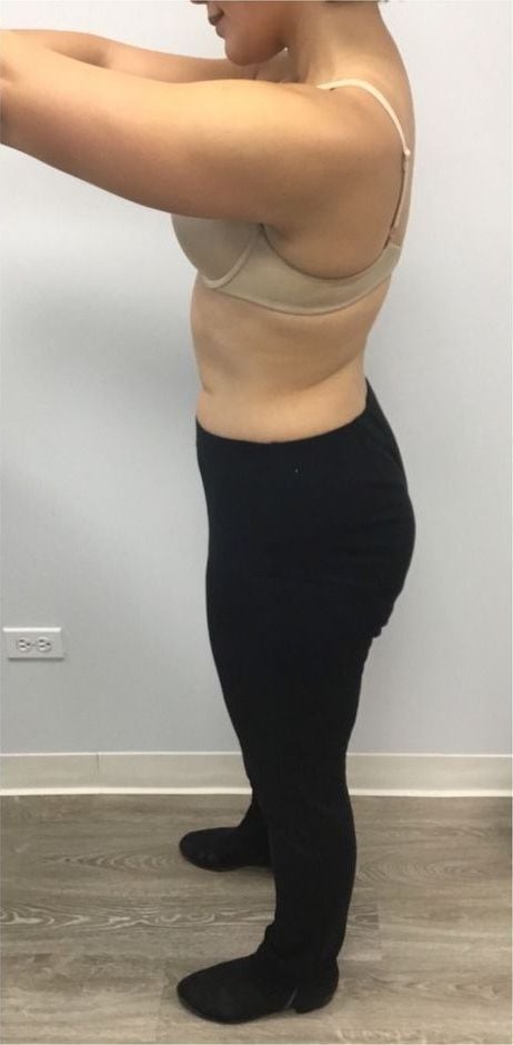 After: Body contouring, abdomen
