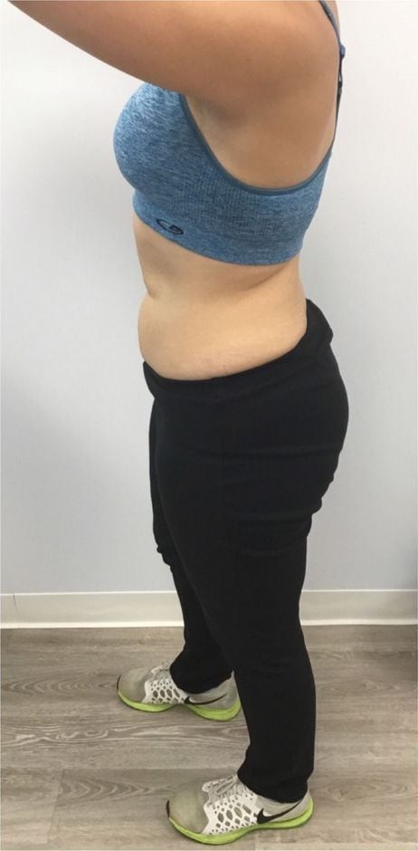 Before: Body contouring, abdomen