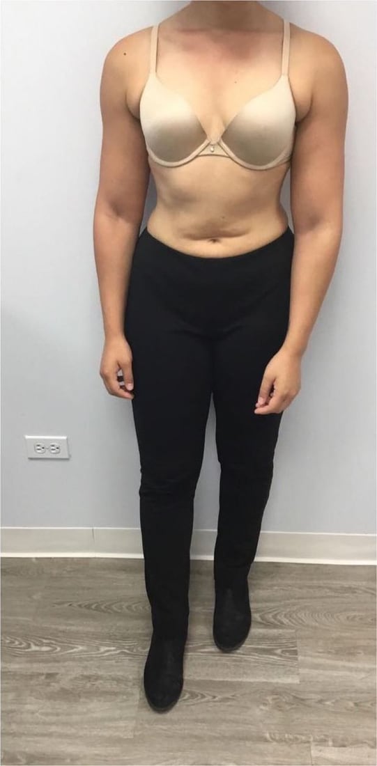 After: Waist and abdomen