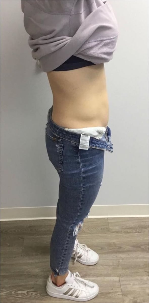 After: Body contouring, abdomen
