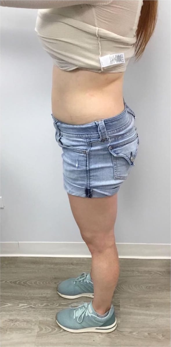 Before: Body contouring, abdomen