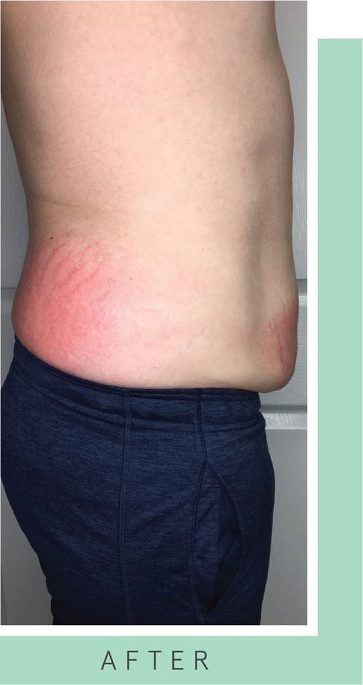 After: Body contouring, abdomen