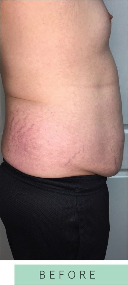 Before: Body contouring, abdomen